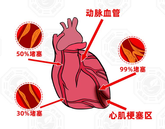 常见的原因全称"心肌梗死"心梗气得捂着胸口歪在沙发上某位集团董事长